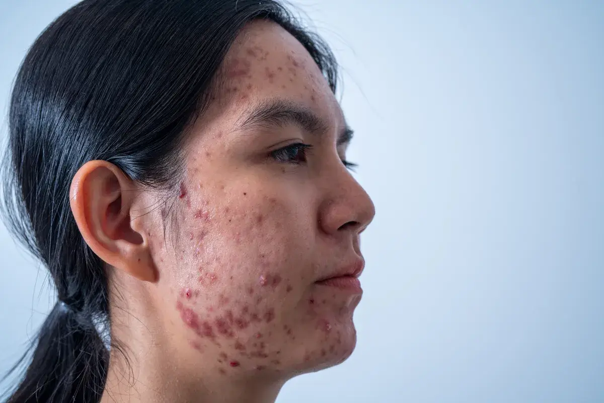 acne-on-face-because-the-disorder